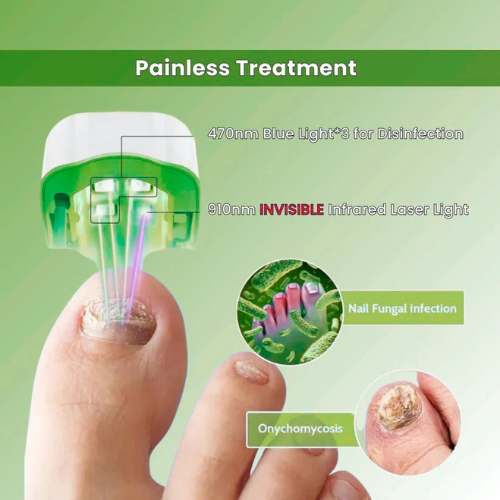 TrindingOnline™ - Nail Fungus Laser