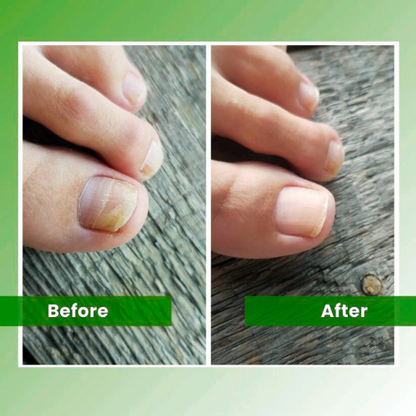 TrindingOnline™ - Nail Fungus Laser