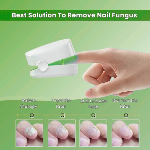 TrindingOnline™ - Nail Fungus Laser